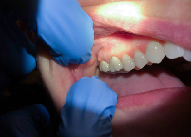 Best Urgent Care for Lost Fillings or Crowns in Cornelius, NC